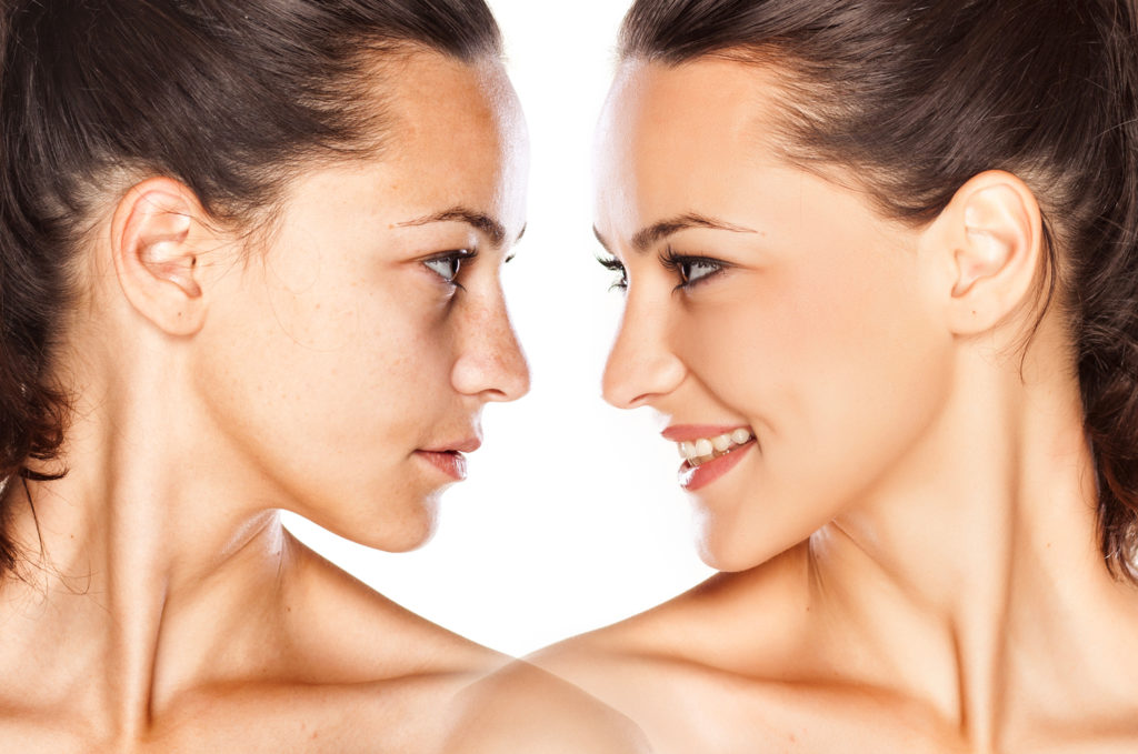 Acne scarring.