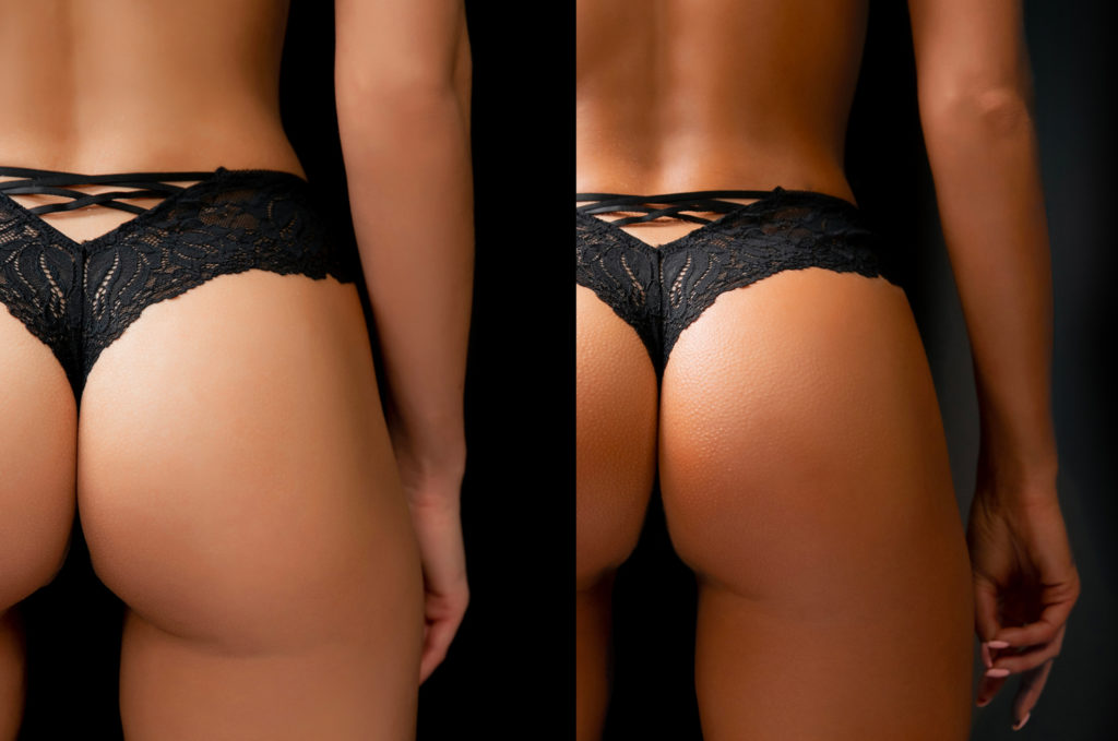 CoolSculpting®