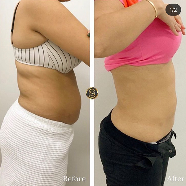CoolSculpting non-surgical fat reduction at Skinatomy Laser Clinic Mississauga