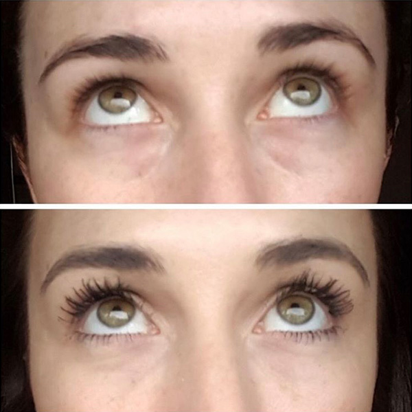Under eye dermal filler results at Skinatomy Laser Clinic Mississauga
