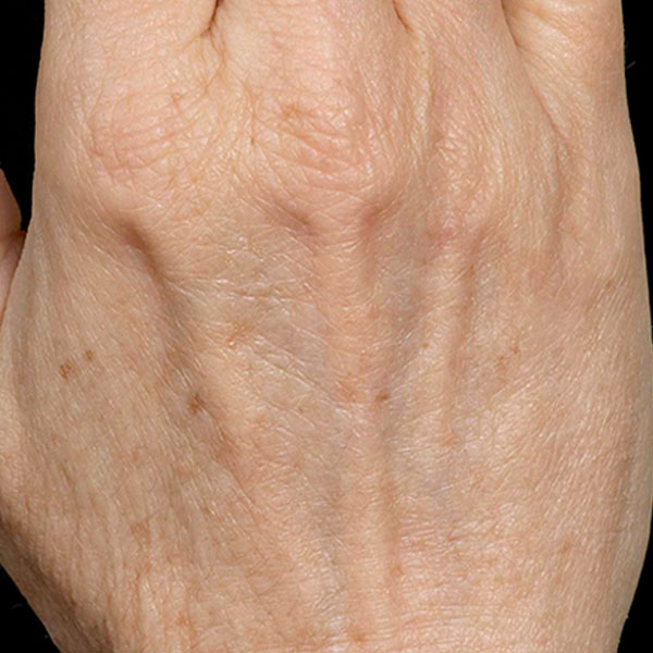 Fraxel laser skin resurfacing results — hands after treatment