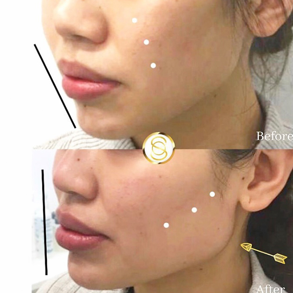 Jawline contouring with dermal filler