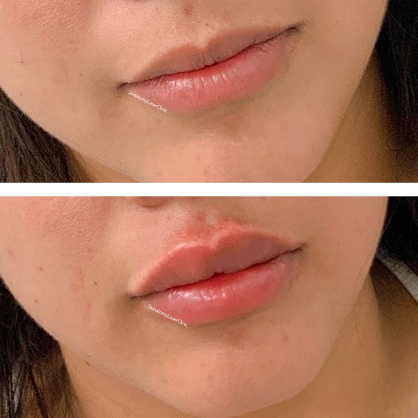 Lip filler results — subtle, natural fullness