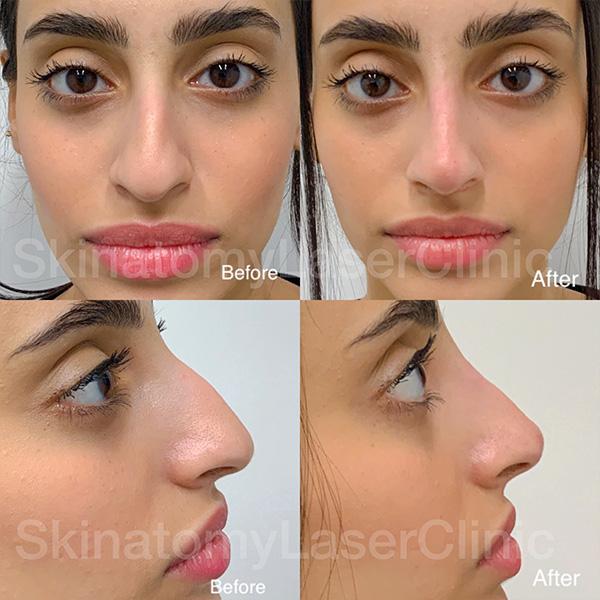 Non-surgical rhinoplasty with dermal filler